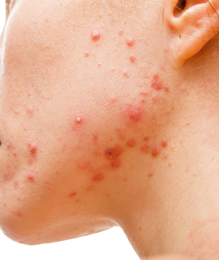 Close-up photo of acne and acne scars on a woman's face