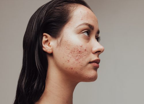 Photo of a woman's side profile. She has visible acne and acne scars on her face.