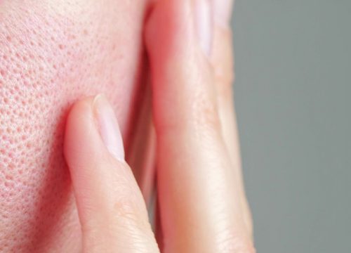 Photo of large pores on a woman's cheek