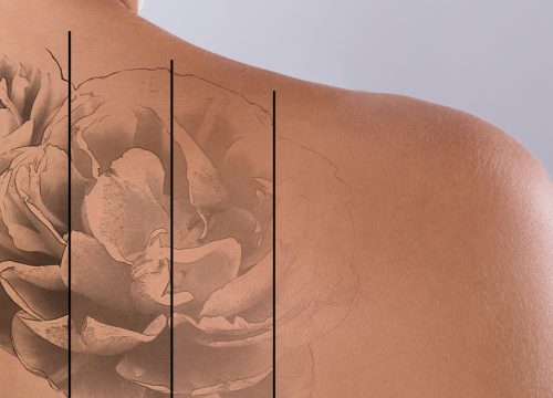 Photo of laser tattoo removal results